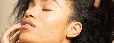 La bataille contre l'acné adulte peut être difficile.Nous parlons aux experts pour le battre